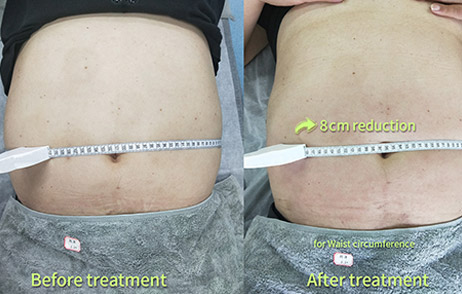 Before & After Treatment-2