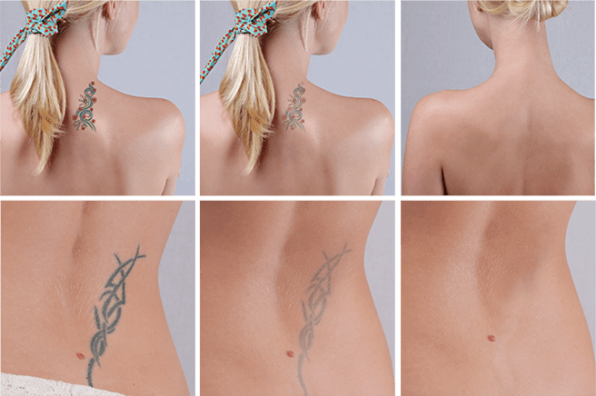 DualPico Laser Tattoo Removal