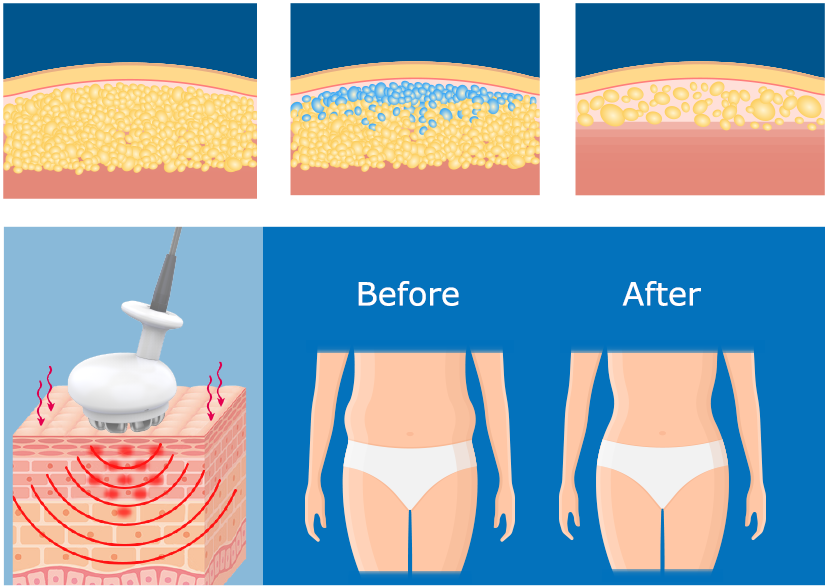 How Radio Frequency Works for Lipolysis