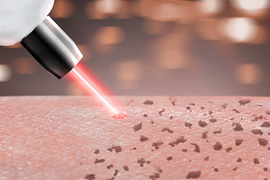 Pico Laser Your Pathway to Brilliant Skin​